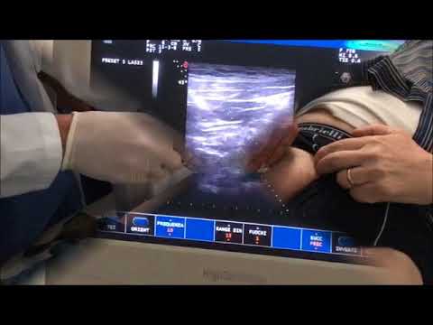 Sublussazione dellarticolazione Spalla struttura ossea articolazione