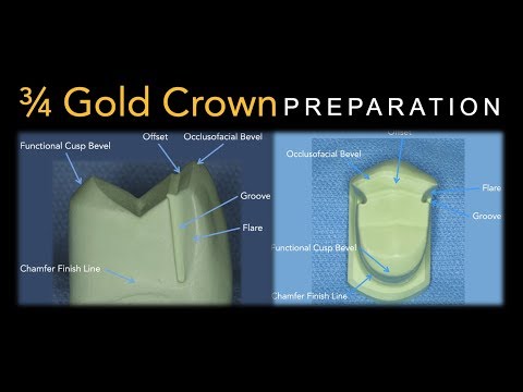 3/4 Goldkronenvorbereitung | Oberkieferprämolar