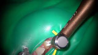 Root canal preparation to MTA obturation with an Ai motor T-mode