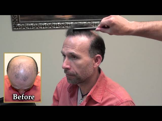 Marius Undetectable Scar
