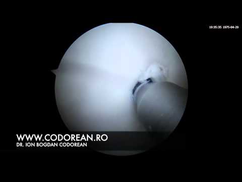 Osteocondrita disecantă