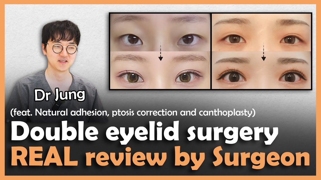 Double Eyelid Surgery Explained