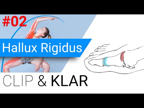 Hallux Rigidus erklärt - Arthrose im Grosszeh Grundgelenk