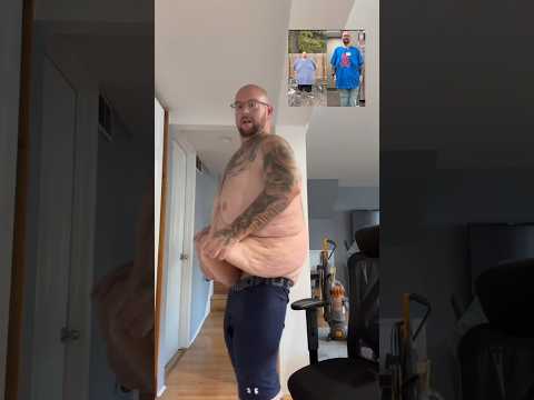 The Truth About Losing Weight: His Loose Skin Story