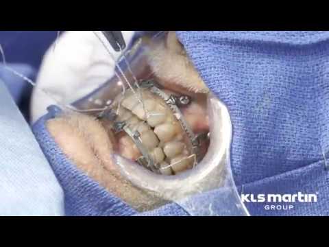 L1® MMF – Surgical Technique