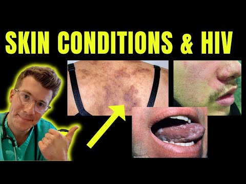 Doctor explains skin conditions associated with HIV / AIDS (e.g. Kaposi sarcoma, candida & more)