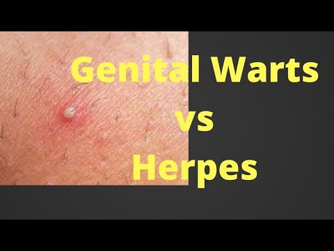 genital skin tags vs warts genital skin tags vs warts