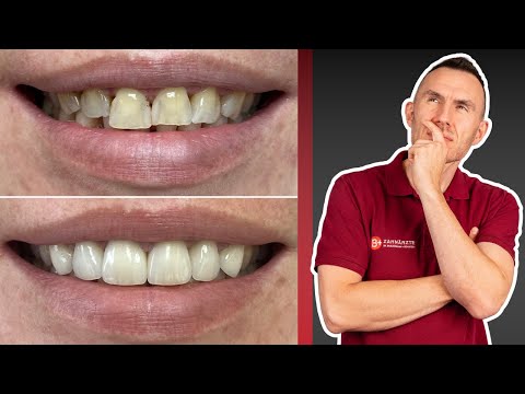 Kunststoff Zahn Veneers: Alternative zu teurer Keramik für deine Zähne? Vorher-Nachher Vergleich!