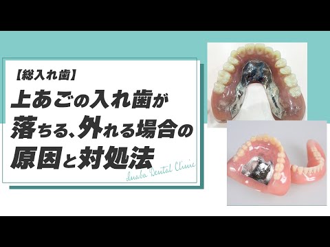 上あごの入れ歯が落ちる、外れる場合の原因と対処法 〜総入れ歯〜