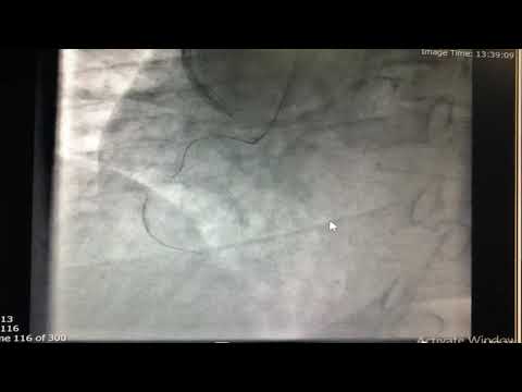 School of complex PCI live in a box CTO session june2020