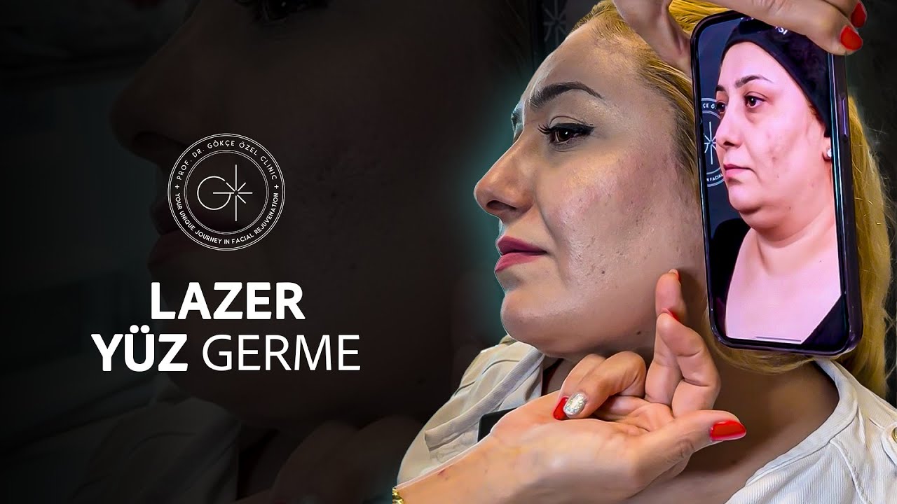 LAZER YÜZ GERME I 17 GÜNDE İNANILMAZ DEĞİŞİM! #ameliyatsızyüzgerme #yüzgerme #yüzgençleştirme