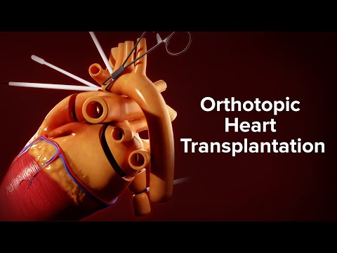 Medical Animation: Orthotopic Heart Transplantation | Cincinnati Children's