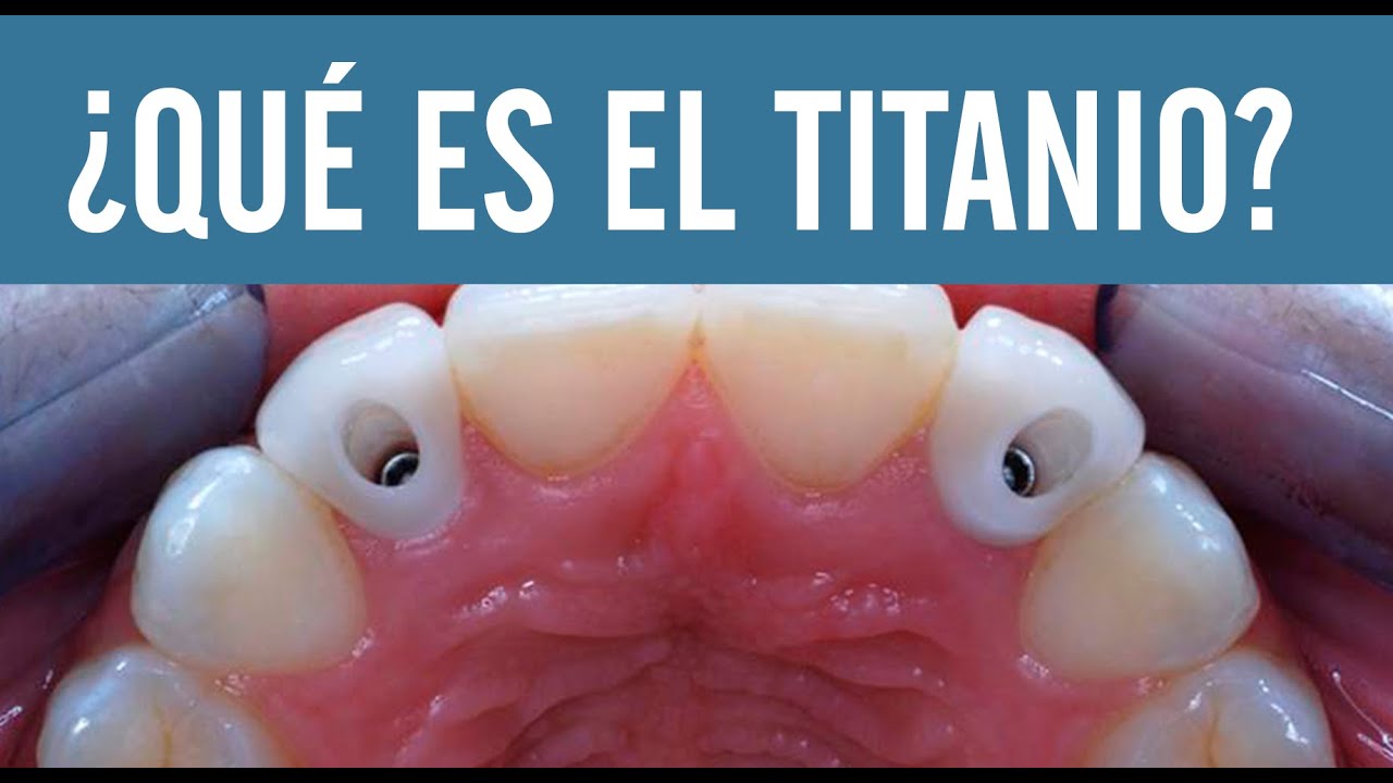 Qué es el titanio | Juan Fernando Salgado | Los implantes dentales