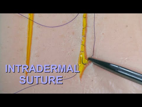 7.  Surgical Sutures. Intradermal Suture.
