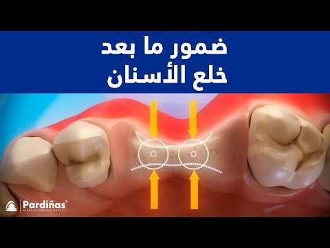ضمور ما بعد خلع الأسنان ©