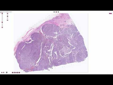 Papilloma virus hpv sintomi