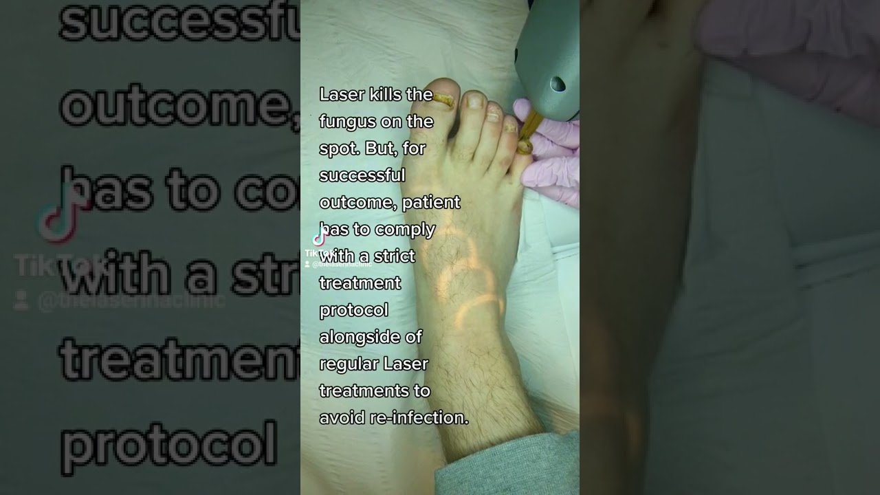 𝗙𝘂𝗻𝗴𝗮𝗹 𝗻𝗮𝗶𝗹𝘀 𝘁𝗿𝗲𝗮𝘁𝗺𝗲𝗻𝘁