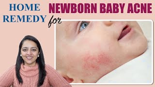 Baby Acne Home Remedy | श‍िशु के चेहरे पर दाने निकलने के कारण और बचाव के उपाय
