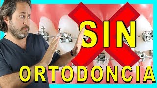 🔷Dientes 𝐓𝐎𝐑𝐂𝐈𝐃𝐎𝐒 𝐒𝐎𝐋𝐔𝐂𝐈𝐎𝐍 sin BRACKETS👍 Como tener los DIENTES RECTOS sin APARATO