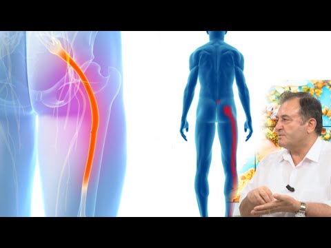 Kujdes! Mos e bëni këtë gabim kur vuani nga nervi shiatik