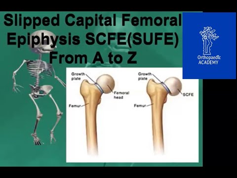 Verrutschte Epiphyse des oberen/kapitalen Femurs für orthopädische Untersuchungen