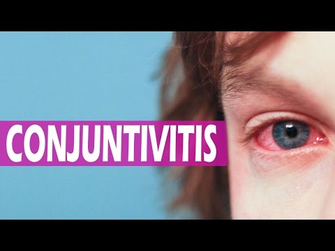 Remedios caseros para la conjuntivitis alérgica y bacteriana – Tratamiento de la conjuntivitis