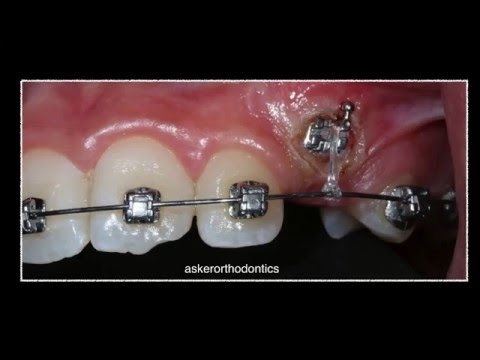 Exposure of Unerupted Canine Using Diathermy