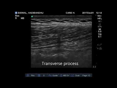 USG guided erector spinae block at lumbar level