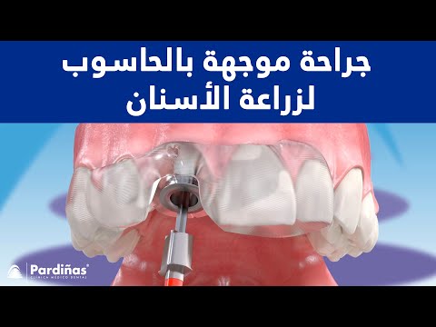 © جراحة موجهة بالحاسوب لزراعة الأسنان