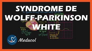 Wolff Parkinson White Syndrome (WPW): ECG, symptômes et traitement