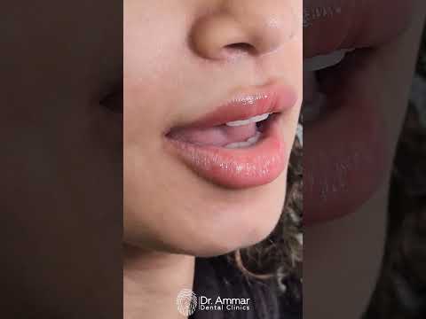 سعودية - فنيرز