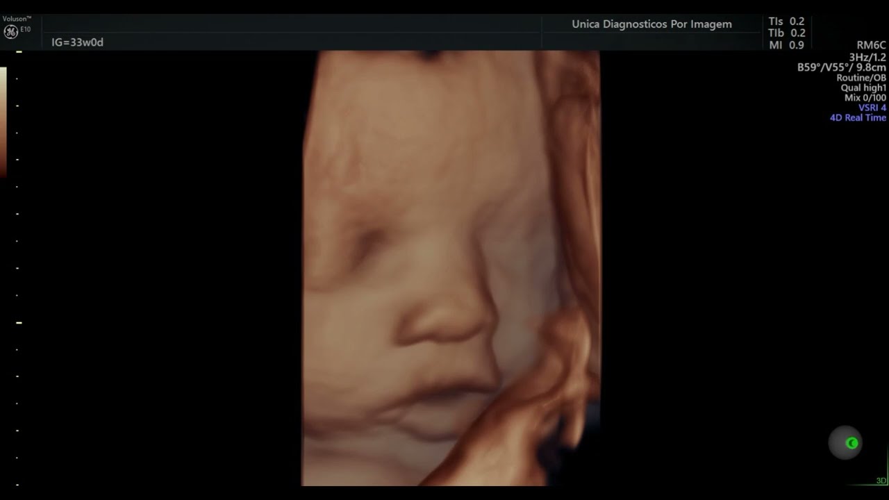 Ultrassom 4D HD Live