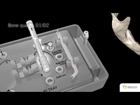 BEGO Semados® Provisorisches Implantat / Provisional Implant