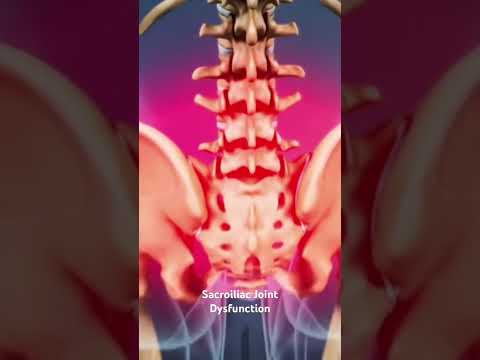 Sacroiliac Joint Dysfunction