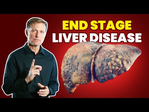 10 Signs of a Dying Liver  (End Stage Liver Disease)