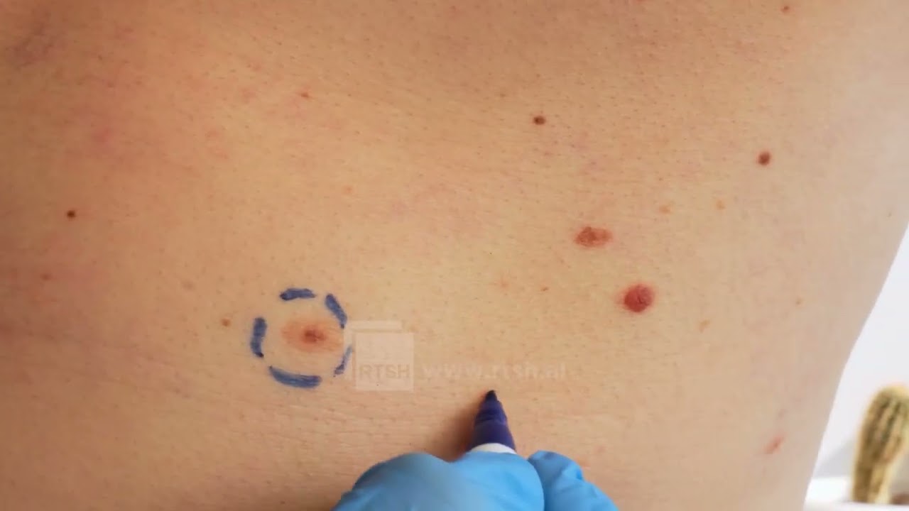 QSUT, pajisje të re për kancerin e lëkurës. Prof. Vasili: Rastet me melanomë po rriten, preken edhe të rinjtë