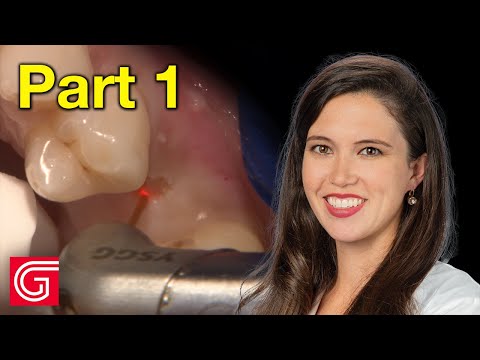 How To Remove an Implant Cover Screw Using a Dental Laser