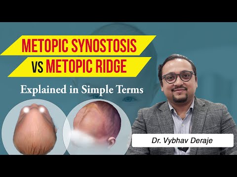 Is Metopic Ridge Dangerous