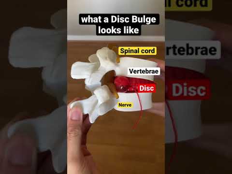 what a Disc Bulge looks like 😲