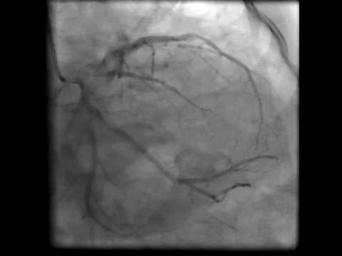 Coronary artery Perforation - Angiogram