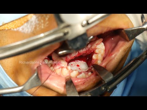Plastic And Reconstructive Surgery Allografts Healing Tissue