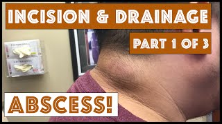 Incision & Drainage of an Infected Cyst - Part 1 of 3