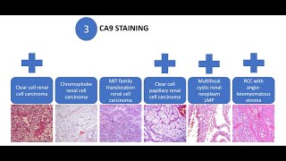 Download Lagu Urologic Pathology #6 Rapid Diagnostic Approach in Renal Tumors with Clear Cell Cytology. Thumbnail