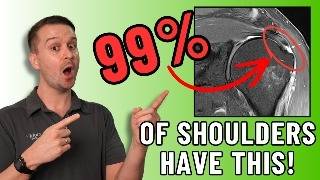 99% of People Over 40 Have a Rotator Cuff 'Abnormality' on MRI