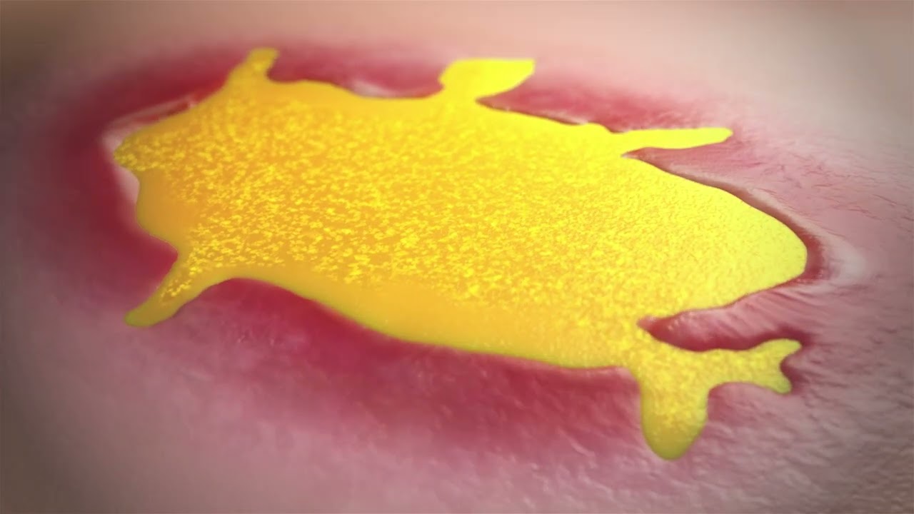 OCM Treatment Overview