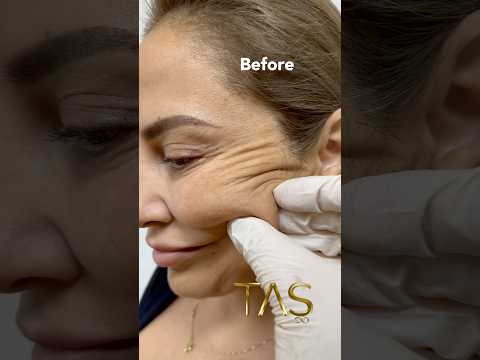 55 years old to back 30 years old 🧜‍♀️ #facelift