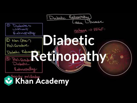 Diabetic retinopathy stages
