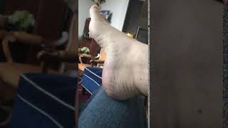 Foot Twitching