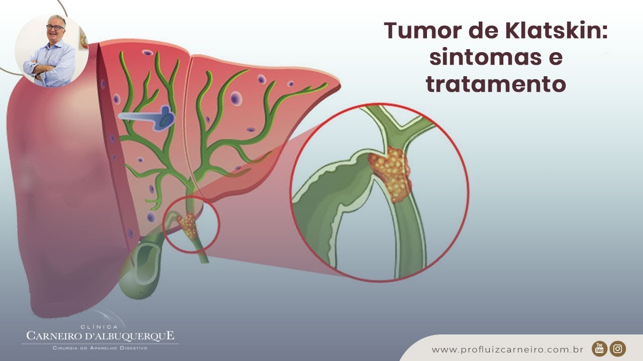 Tumor de Klatskin: sintomas e tratamento | Prof. Dr. Luiz Carneiro CRM 22.761