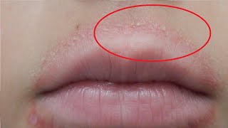 how to get rid of allergic reaction on lips